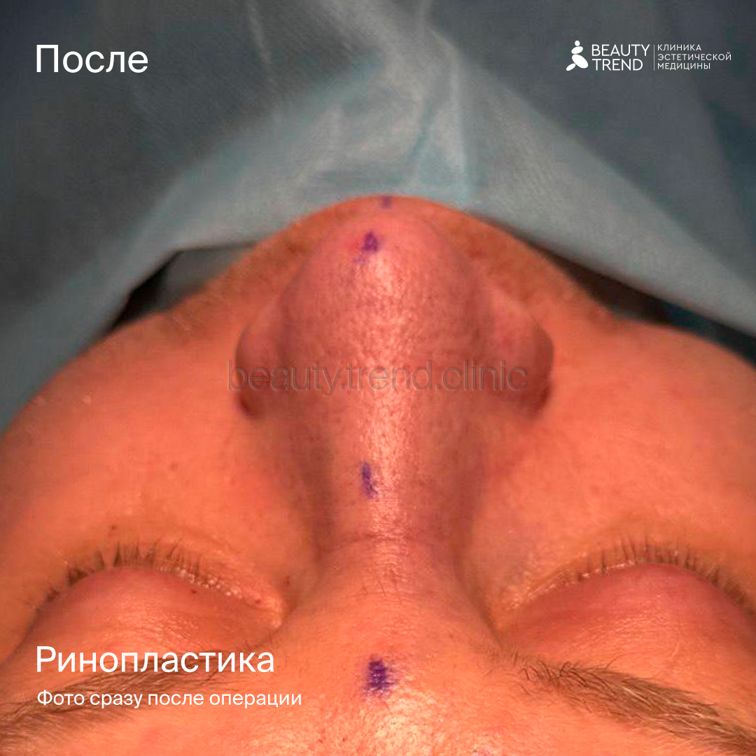 Ринопластика До/После - после 1